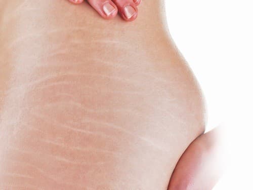 Phần lớn các mẹ bầu đều bị rạn da từ tháng thứ 4 của thai kì. 