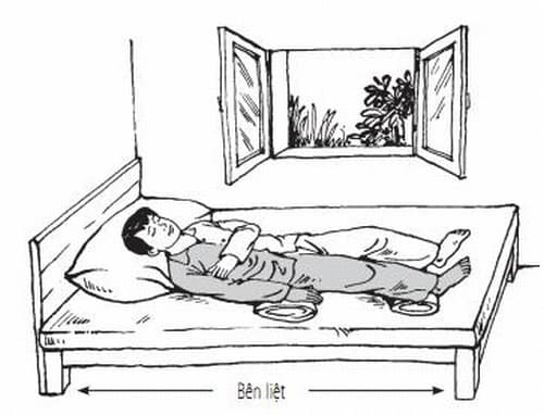 Liệt nửa người ảnh hưởng nghiêm trọng đến sức khỏe và hoạt động của bệnh nhân