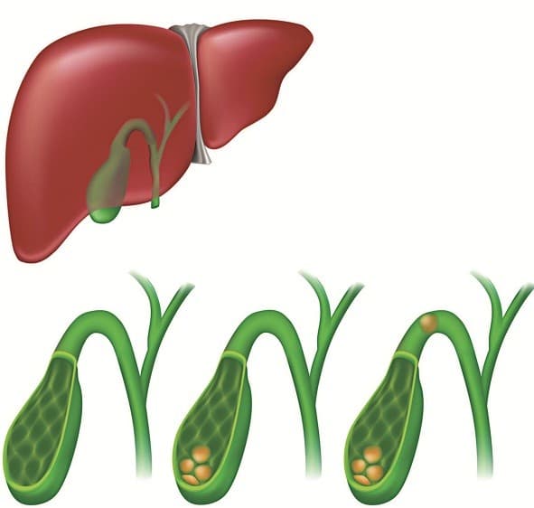 Nguyên nhân chủ yếu gây viêm túi mật cấp là do sỏi túi mật