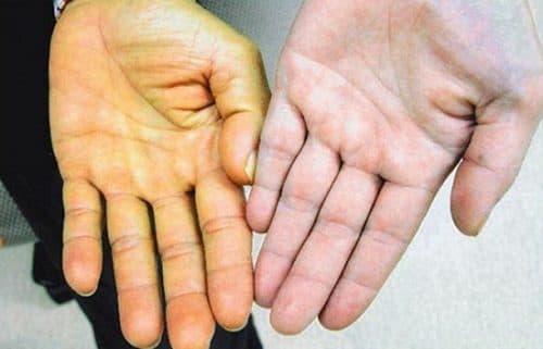 Vàng da... là một trong những cách nhận biết ung thư gan