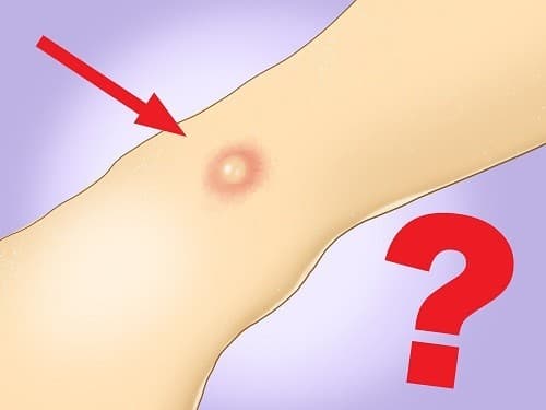 Cắt u bã đậu được đánh giá là phương pháp điều trị triệt để nhất, giúp loại bỏ toàn bộ khối u và vỏ bọc của nó