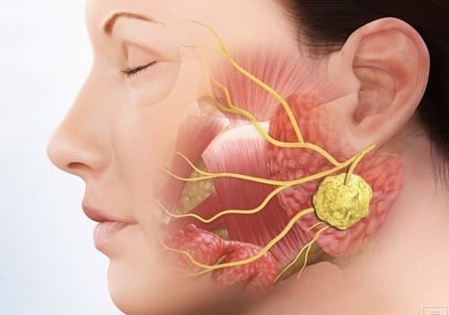 Ung thư tuyến nước bọt là bệnh hiếm gặp nhưng rất nguy hiểm nên cần được phát hiện và điều trị sớm.