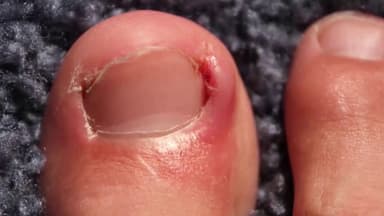 Cách chữa chín mé hiệu quả