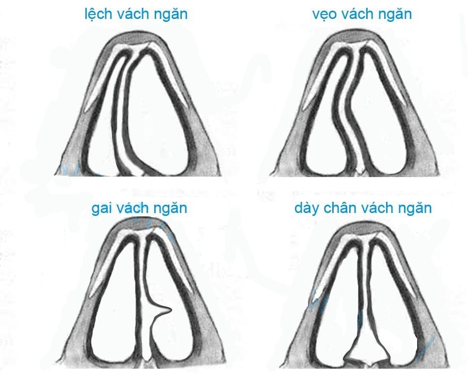 Chỉnh hình vách ngăn mũi được thực hiện như thế nào?