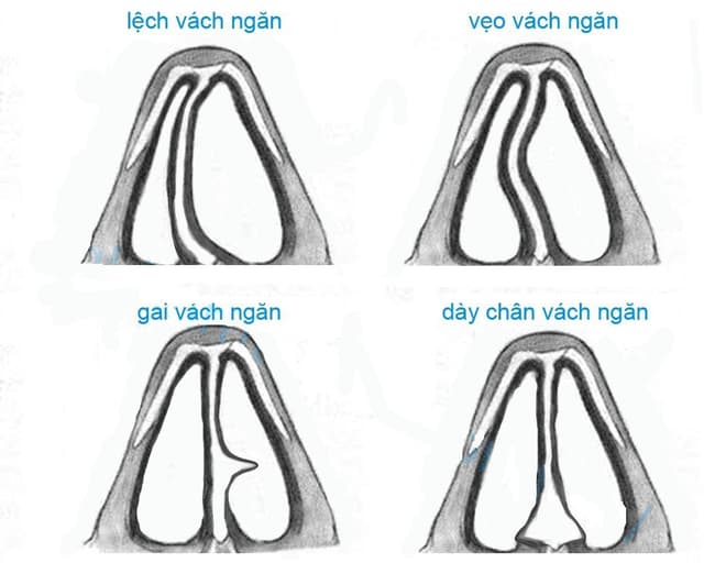 Chỉnh hình vách ngăn mũi được thực hiện như thế nào?