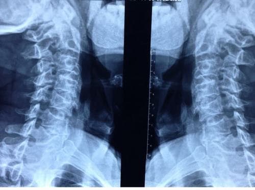 Chụp X quang giúp phát hiện tình trạng thoái hóa