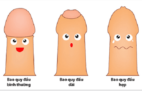 Khi đang băn khoăn có nên cắt bao quy đầu không, nam giới cần theo dõi và xác định tình trạng bao quy đầu của mình