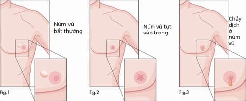 Các dấu hiệu ung thư vú ở nam giới thường giống với triệu chứng bệnh ở nữ