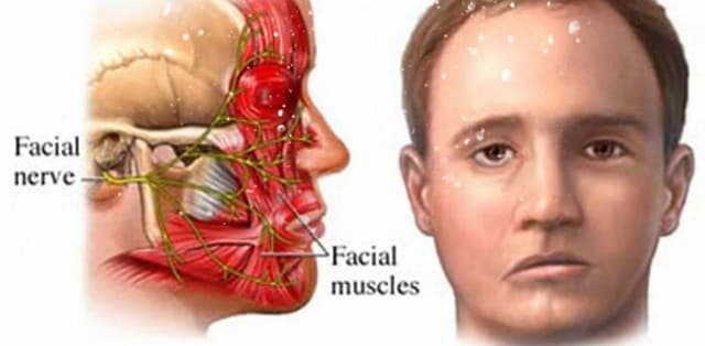 Điều trị bệnh liệt dây thần kinh số 7 ngoại vi