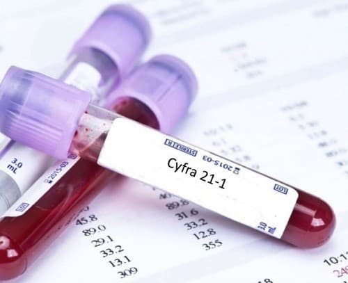 Định lượng CYFRA 21-1 là một chất chỉ điểm ung thư thường dùng trong hỗ trợ chẩn đoán và theo dõi điều trị ung thư phổi.