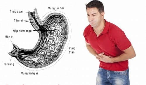 Đau dạ dày là bệnh khá phổ biến do nhiều nguyên nhân như nhiễm vi khuẩn HP, chế độ ăn uống không phù hợp