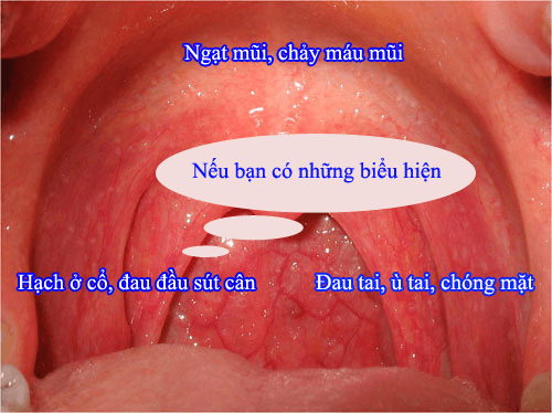 Hình ảnh ung thư vòm họng - Triệu chứng
