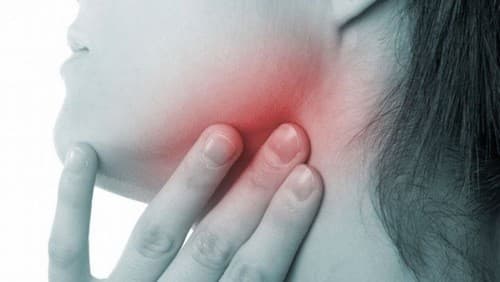 Hình ảnh ung thư vòm họng - Giai đoạn đầu, bệnh nhân có thể nổi hạch ở góc hàm