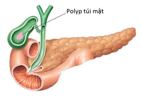 Polyp túi mật cần được phát hiện sớm và điều trị hiệu quả