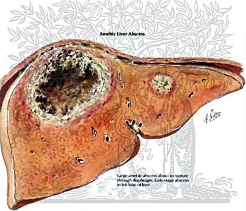 Áp xe gan nếu không được điều trị hiệu quả có thể gây biến chứng nguy hiểm