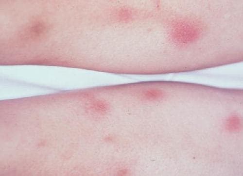 Các nốt đỏ có kích thường từ 2 - 6 cm