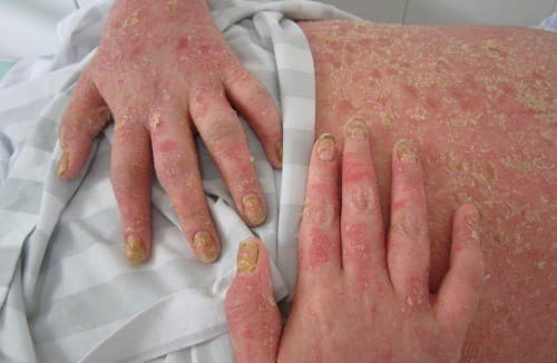 Viêm khớp vảy nếu có các dấu hiệu và triệu chứng giống viêm khớp dạ thấp.