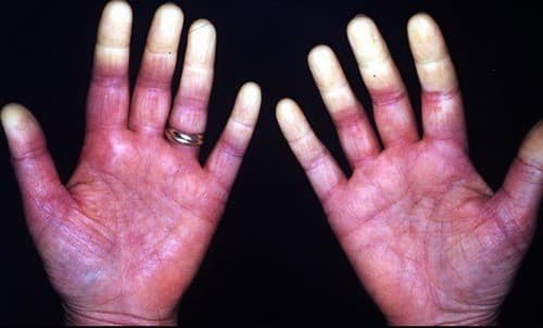 Hội chứng Raynaud là triệu chứng của nhiều bệnh lý trong cơ thể nhất là tình trạng rối loạn vận mạch, co thắt mạch máu. 