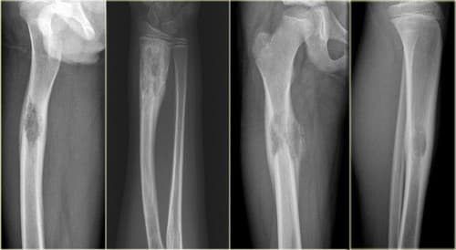 U tế bào khổng lồ là dạng u xương lành tính 