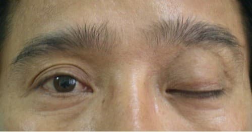 Triệu chứng liệt dây thần kinh số 3