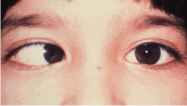 Liệt dây thần kinh số 4 cần được phát hiện sớm và điều trị hiệu quả