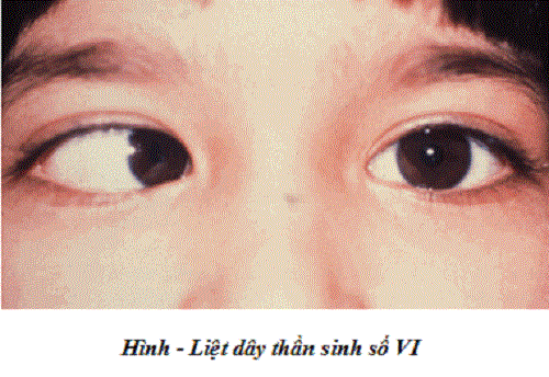 Liệt dây thần kinh số 6 phải làm sao triệu chứng 