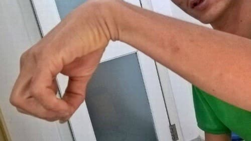 Triệu chứng liệt dây thần kinh quay