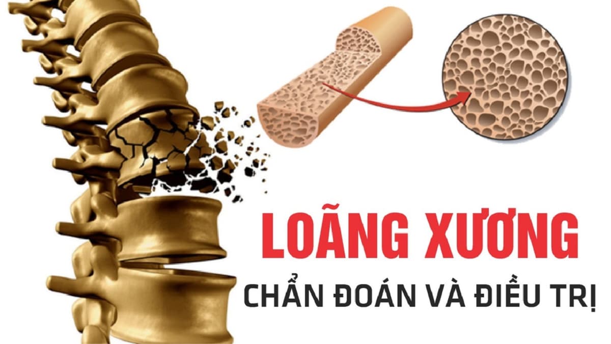 Chẩn đoán và điều trị bệnh loãng xương