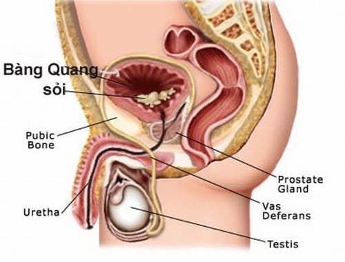 Sỏi bàng quang cần được phát hiện sớm và điều trị hiệu quả