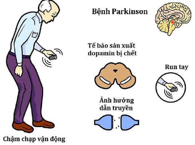 nguyên nhân gây hội chứng parkinson