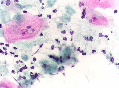 nhiễm nấm Candida khiến người bệnh không khỏi lo lắng