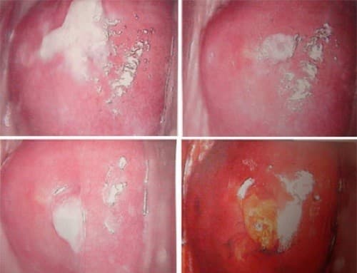 Nấm phụ khoa Candida có thể gây ảnh hưởng xấu tới sức khỏe sinh sản nếu không được phát hiện và xử trí kịp thời