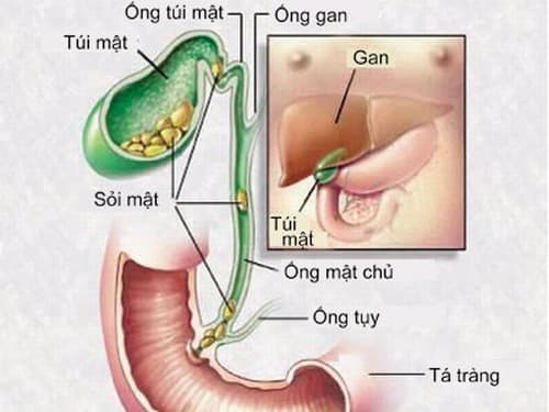Sỏi đường mật có thể do nhiều nguyên nhân gây ra