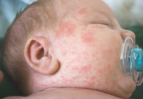 Sốt xuất huyết có các triệu chứng như: sốt cao đột ngột. đau nhức xương khớp, da đỏ xung huyết, ban xuất huyết, đốm xuất huyết, chảy máu chân răng, chảy máu cam,….