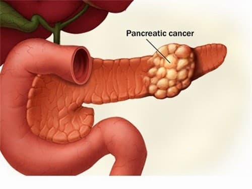 Ung thư tuyến tụy là khối u ác tính nguyên phát từ biểu mô của tuyến tụy và các mô liên kết. 