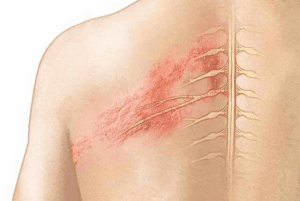 Zona thần kinh thường khu trú tập trung ở có một bên của cơ thể, dọc theo các đường dây thần kinh