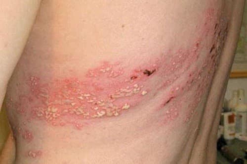 Zona thần kinh thường bắt đầu là các mảng đỏ, nề nhẹ, gờ cao hơn mặt da, hình tròn, bầu dục lần lượt nổi dọc dây thần kinh