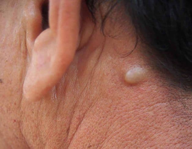 Người mắc u bã đậu có những biểu hiện thông thường giống như nổi mụn bọc vì vậy nhiều người nhầm tưởng với mụn, nhọt