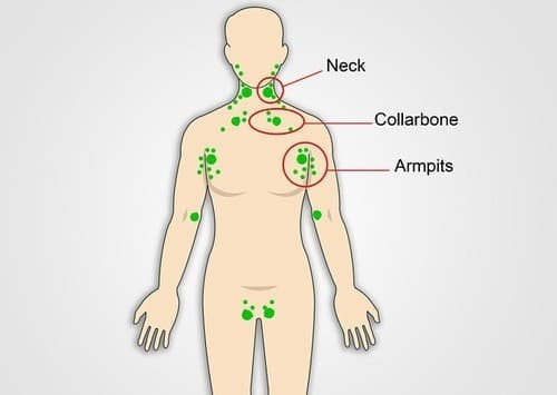 Bệnh ung thư hạch bạch huyết là bệnh nguy hiểm nên cần được phát hiện và điều trị sớm