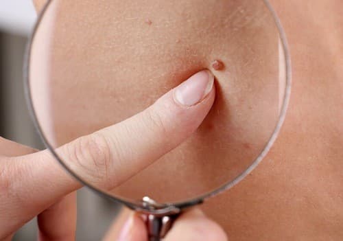 Ung thư da là sự phát triển không kiểm soát được của các tế bào bất thường trên da. 