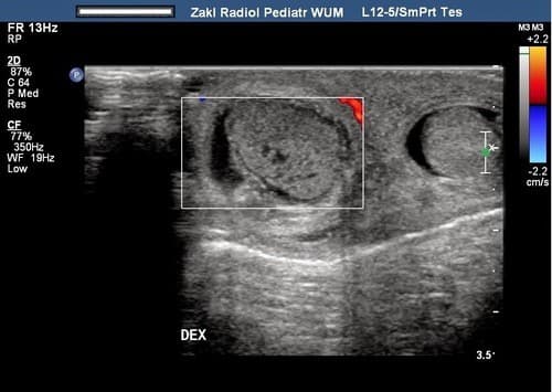 Siêu âm là một trong những phương pháp giúp phát hiện sớm ung thư tinh hoàn