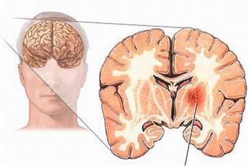 Hiện tượng chảy máu não có thể xảy ra bên trong, giữa và màng bao bọc não, giữa các lớp màng não hay giữa hộp sọ và phần bao ngoài của não.