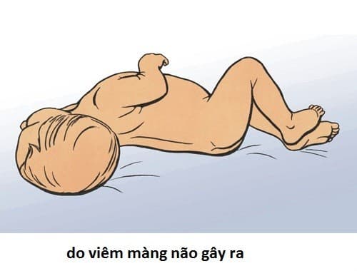 xuat-huyet-nao-o-tre-em-2