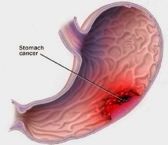 xung-huyet-da-day-nen-an-gi-1