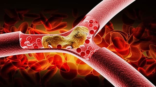 Chỉ số mỡ máu bình thường và cách phòng ngừa bệnh hiệu quả