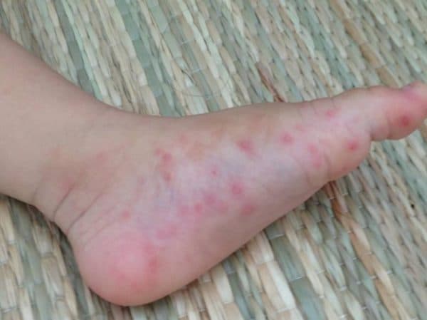 benh-tay-chan-mieng-4