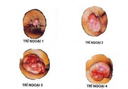 Bệnh trĩ ngoại được chia thành 4 cấp độ