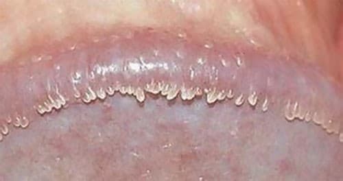 Có nên đốt gai sinh dục