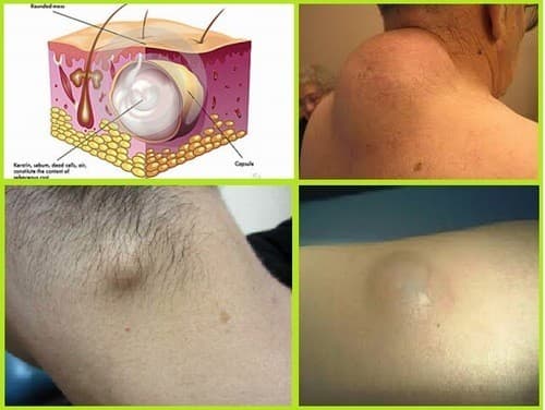 Dấu hiệu nhận biết u bã đậu