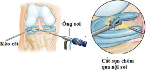 Phẫu thuật điều trị rách sụn chêm hiệu quả